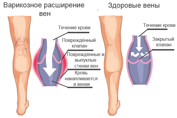 Варикозное расширение вен: советы Аюрведы 