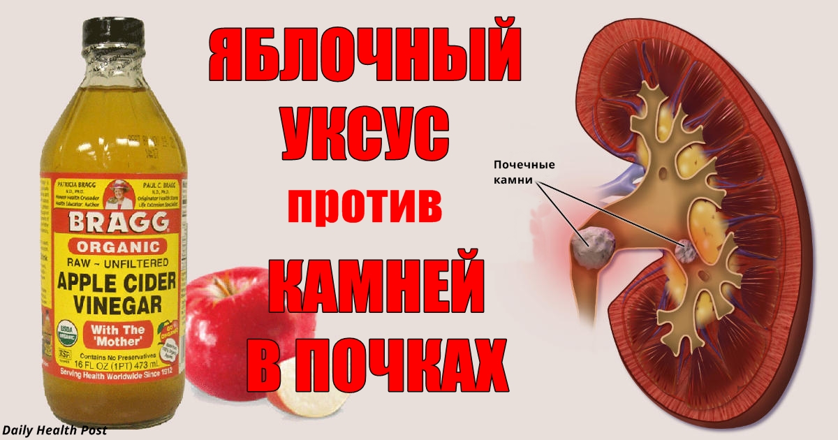 Вот 4 народных способа растворить камни в почках. Нужен только уксус! 