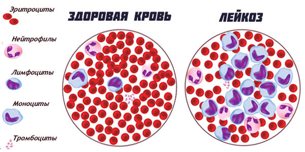 Майкл Грегер: Как не умереть от рака крови