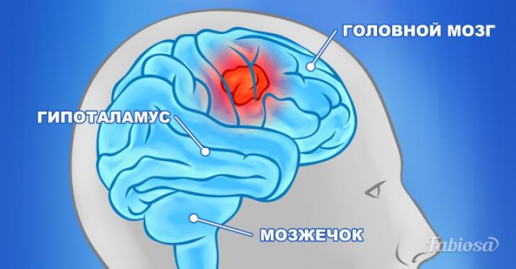 10 симптомов, причиной которых может быть опухоль мозга