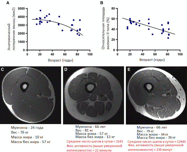 Саркопеническое ожирение: жир вместо мышц