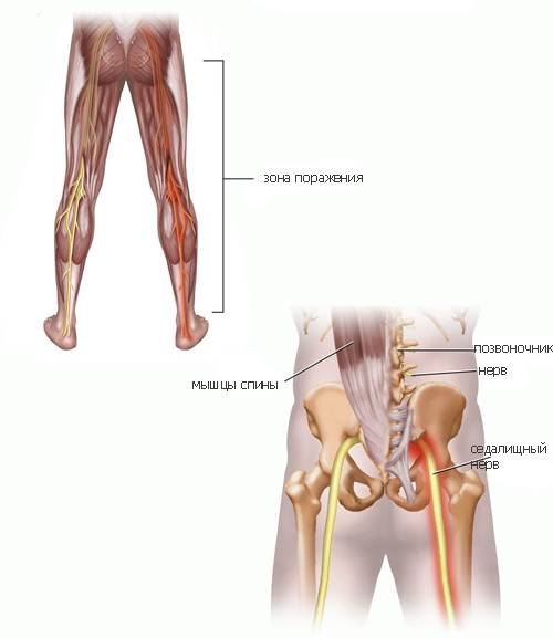Причины и лечение ишиаса, ложного артроза и «синдрома грушевидной мышцы»