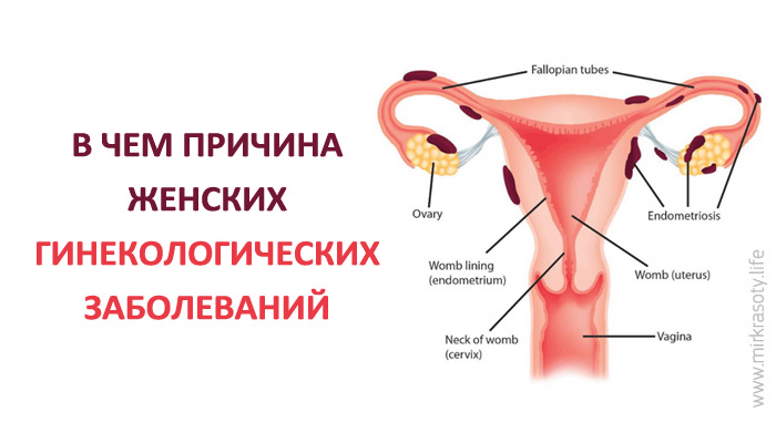 Основная причина гинекологических заболеваний у женщин