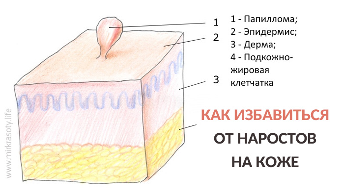 Как избавиться от «висюлек» на коже