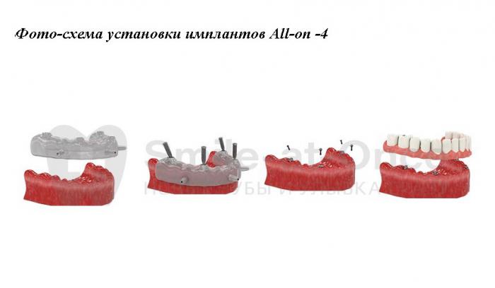 Протезирование за 1 день. Особенности all-on-4