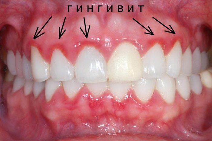 15 веских причин, которые убедят в том, что нужно чистить зубы