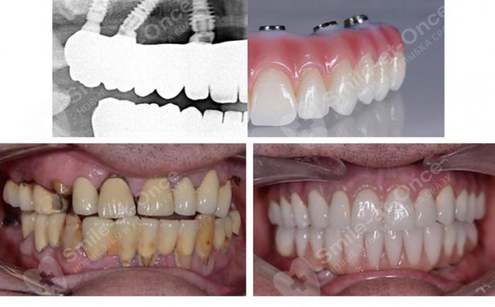Протезирование за 1 день. Особенности all-on-4