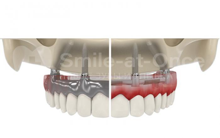 Протезирование за 1 день. Особенности all-on-4