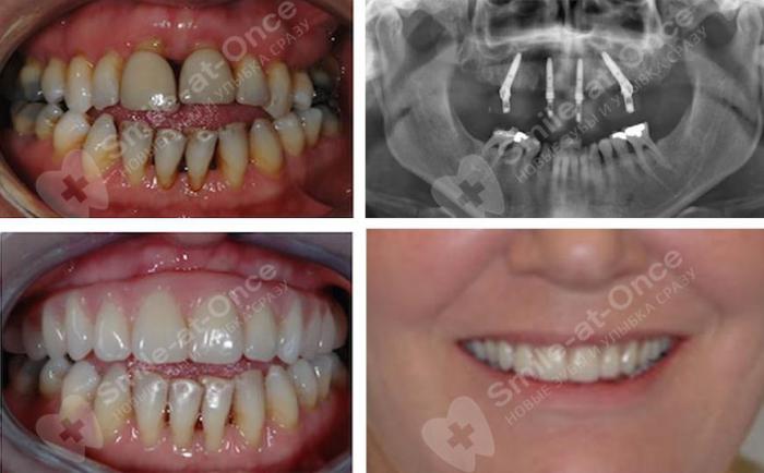 Протезирование за 1 день. Особенности all-on-4