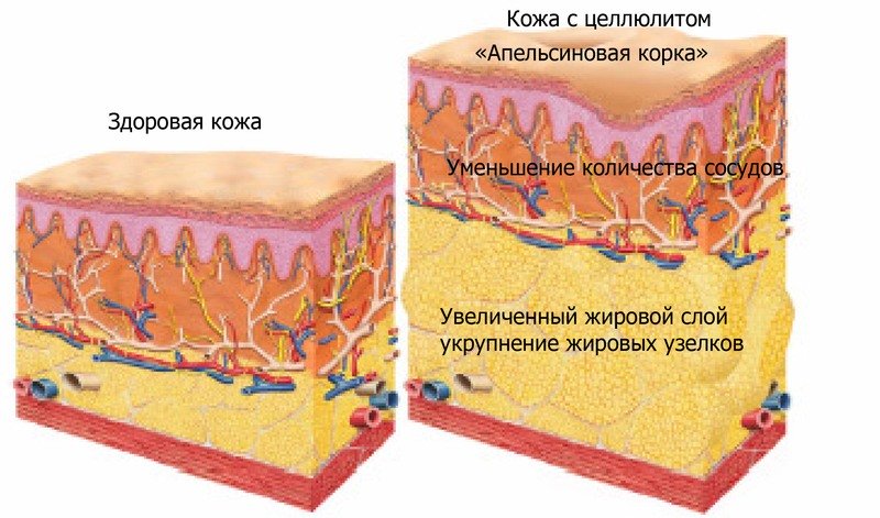 Волшебный напиток от целлюлита