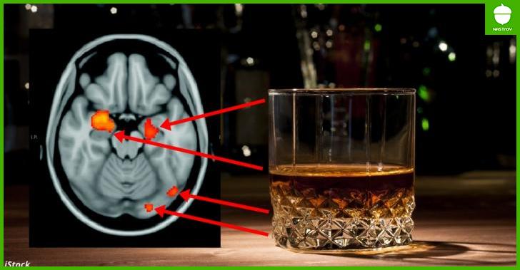 Даже умеренное потребление алкоголя вызывает атрофию мозга! Новое исследование