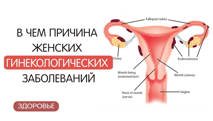 Основная причина гинекологических заболеваний у женщин