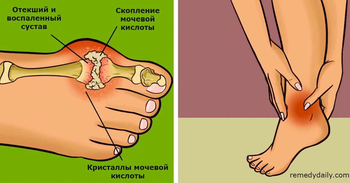 10 продуктов, которые надо есть, чтобы держать под контролем уровень мочевой кислоты