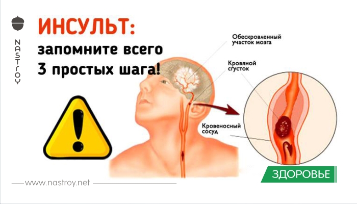 Инсульт: три шага, чтобы спасти жизнь себе или близким