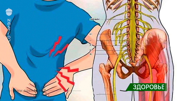 Воспаление седалищного нерва: достаточно 1 легкого упражнения, чтобы избавиться от боли всего за 5 минут!