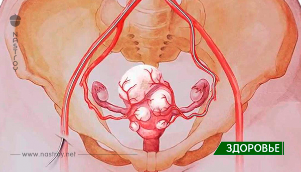 Уничтожить все миомы и кисты можно просто употребляя эти 3 напитка! Всего через месяц вы забудете о них!