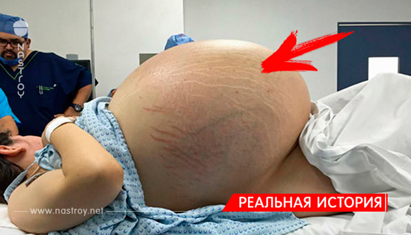 В больнице все решили, что эта женщина находиться на позднем сроке беременности. Но когда врачи сделали рентген её живота… (7 фото)