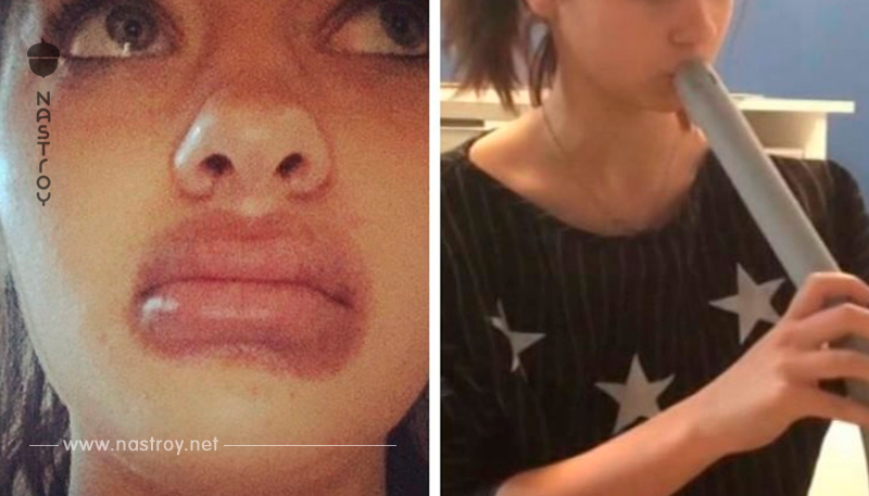 19-летняя ростовчанка попыталась увеличить губы пылесосом. Вот что вышло!!!