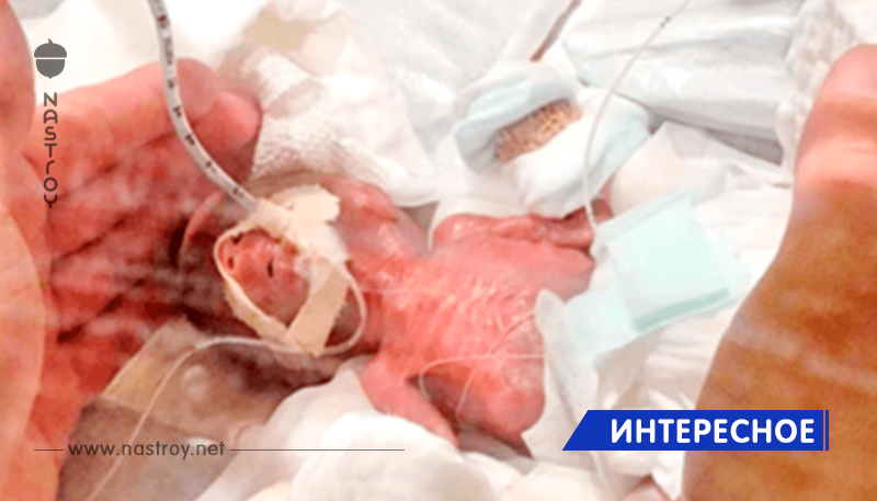 Ребёнок весом 268 граммов: выписали самого маленького новорожденного в мире
