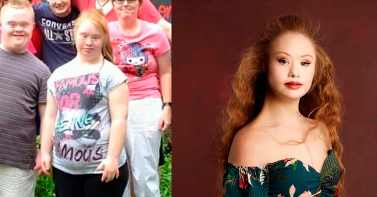 Девушка с синдромом Дауна похудела на 40 кг   и стала моделью
