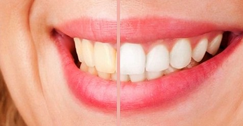 Отбеливание зубов 100% натуральным средством, которое также устранит зубной камень, микробы и желтые пятна!