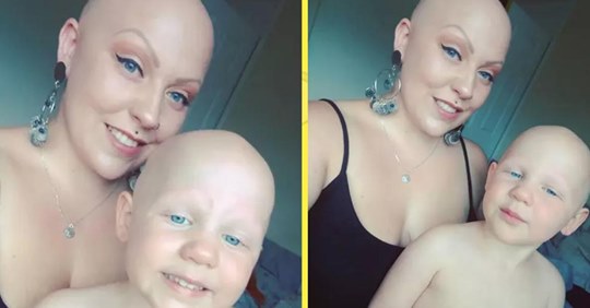 Облысевшая мама решила не носить парики ради дочери, которая тоже страдает алопецией 