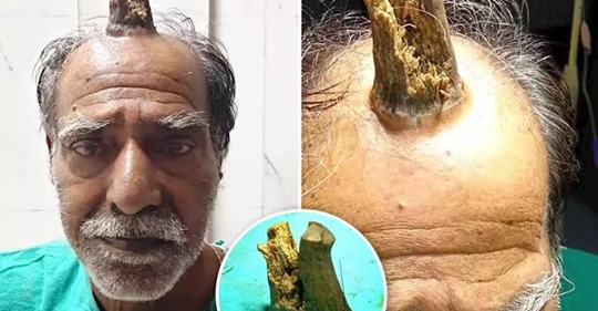 Человек единорог: 74 летнему индийцу удалили жуткий нарост на голове