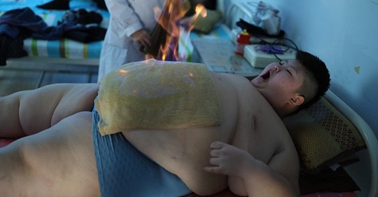  11-летний китаец весом 150 килограммов пытается похудеть с помощью огня