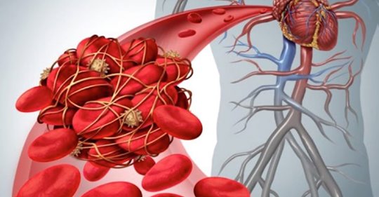 9 безопасных, натуральных разбавителей крови для уменьшения сгустков крови (тромбоз) и риска инсульта
