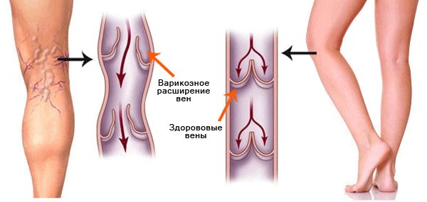 Варикоз: чудо мазь для лечения сосудистых звёздочек