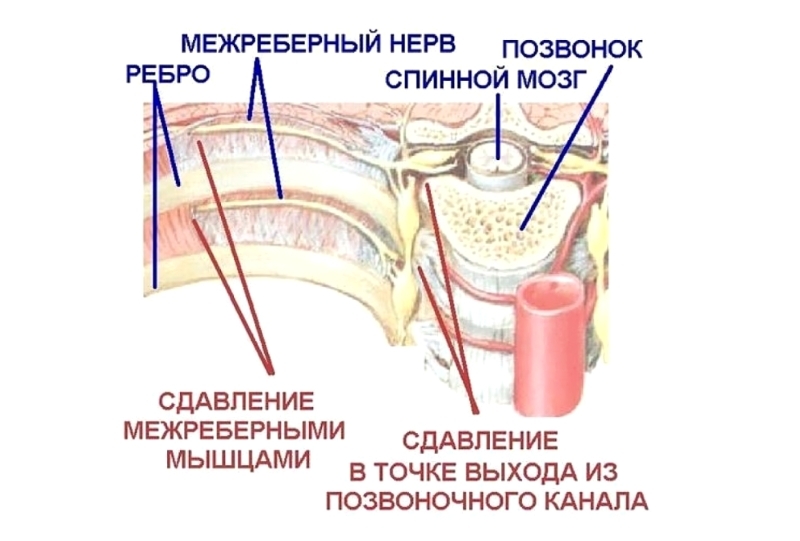 Защемление межреберного нерва. Межребепная неврология. Межреберная нейровлагия. При межреберной невралгии. Воспаление межреберного нерва.