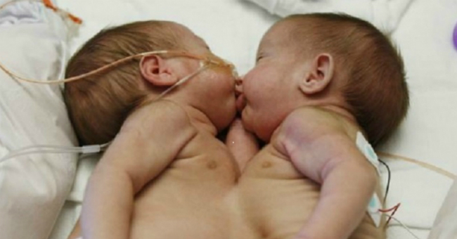 Они родились с одной грудной клеткой на двоих. Родители приняли решение их разделить, и спустя 2 года их не узнать!