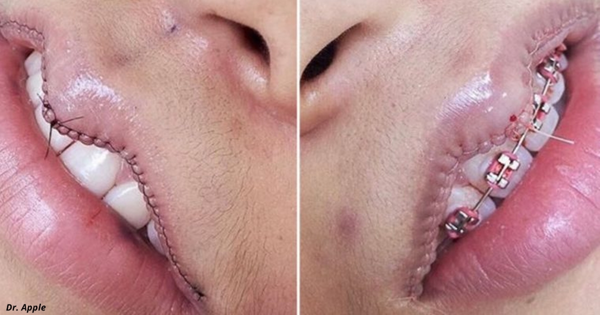 У гламурных девушек в Instagram новая фишка - операции по УМЕНЬШЕНИЮ губ! 